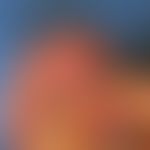 Pseudozyste der Aurikula:&nbsp;Operationssitus, Eröffnung der Pseudozyste.
