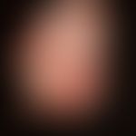 Psoriasis arthropathica, most severe ankylosing form, infestation of the fingers, fixation in a b...