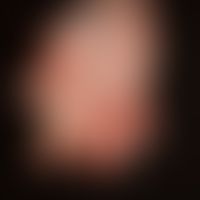 Psoriasis arthropathica. Schwerste ankylosierende Form, Befall der Finger, Fixierung in Beugestel...