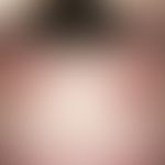 Psoriasis capitis: chronically inpatient, intermittently worsening red spot on the forehead, loca...