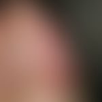 Psoriasis capitis. solitary, chronically stationary, sharply defined, silvery scaly plaque that e...