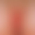 Psoriasis intertriginosa: chronic, intertriginous focus with maceration in the rima ani. intermit...