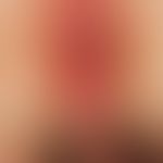 Psoriasis intertriginosa: circumscribed, sharply defined, red, rough plaque with erosion and mace...