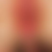 Psoriasis intertriginosa: Umschriebene, scharf begrenzte, rote, raue Plaque mit Erosionen und Maz...