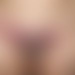 Psoriasis intertriginosa. solitary, chronically stationary, large, sharply edged, especially afte...