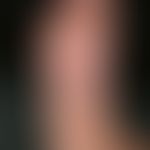 Psoriasis palmaris et plantaris. sharply defined plaque with blisters (lower left), rhagades and ...