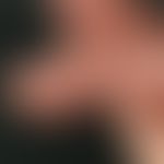 Dry keratotic plaque type Chronically active, intermittent plaques, which have existed for more t...