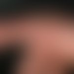 Dry keratotic plaque type Chronically active, intermittent plaques, plaques and rhagades in a 48-...