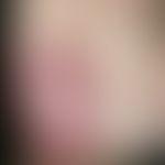 Psoriasis palmaris et plantaris: Plaque type with dyshidrotic vesicles and pustules. 22-year-old ...