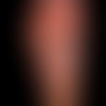 Psoriasis palmaris et plantaris: dry keratotic plaque type. Pretreated psoriasis plantaris: typic...