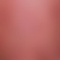 Psoriasis vulgaris Exanthematic psoriasis vulgaris with coin-sized, coarsely lamellar scaling, er...