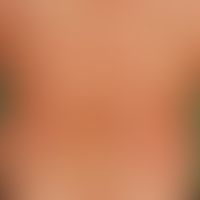 Psoriasis vulgaris. Psoriasis guttata. 48 Jahre alter Patient. Diskrete stationäre Psoriasis vulg...