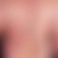 Psoriasis vulgaris.&nbsp;Plaque-Psoriasis. Der 54 Jahre alte Patient leidet seit etwa 30 Jahren a...