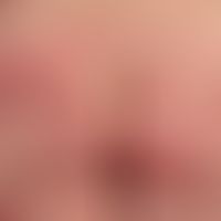 Psoriasis vulgaris. general view: multiple, solitary or confluent, nummular or large-area, erythr...