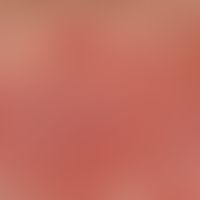 Psoriasis vulgaris. detail enlargement: flat, erythrosquamous plaque as well as smaller erythrosq...