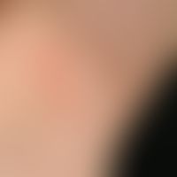 Psoriasis vulgaris. Detailausschnitt: Chronisch dynamische, in rezidivierenden Schüben auftretend...