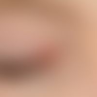 Psoriasis vulgaris. Lokalisierte Psoriasis. Chronisch dynamische, in rezidivierenden Schüben auft...