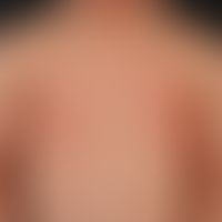 Psoriasis vulgaris. psoriasis guttata. general view: Multiple, chronically inpatient, disseminate...