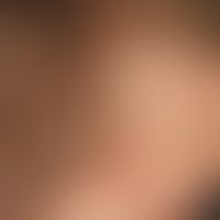Psoriasis vulgaris. Kopfhautpsoriasis (unbhandelter Zustand).&nbsp;Chronisch stationäre, am Kapil...
