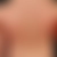 psoriasis vulgaris. psoriasis guttata. general view: several, chronically inpatient, on the back ...