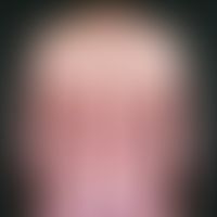 Psoriasis vulgaris. 52-year-old patient with known psoriasis, which has been increasingly affecti...