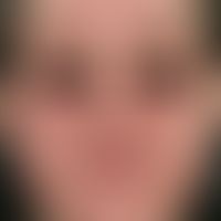 psoriasis vulgaris. seborrhoid psoriasis. large, flat, red, rough plaques with fine-lamellar scal...