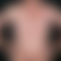 Psoriasis vulgaris. psoriatic erythroderma. spread of psoriasis vulgaris as a maximum variant ove...