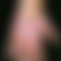 Psoriasis vulgaris. psoriasis palmaris. nummular and flat, reddened plaques with coarse lamellar,...