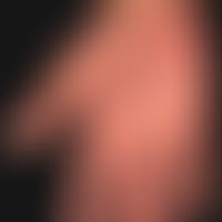 Psoriasis vulgaris.&nbsp;Palmo-plantare Psoriasis mit Pustelbildung und zahlreichen dyshidrotisch...