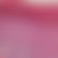 Psoriasis vulgaris, chronisch-stationäre. Detailvergrößerung: Intrakorneale Ansammlungen von neut...