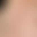 Pulicosis. multiple, acute, for one day existing, on the right side of the neck (randomly) locali...