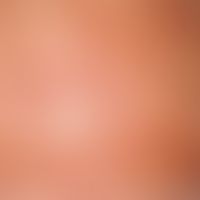 PEP. Severe itching, red papules on the trunk of a 26-year-old pregnant woman in the 3rd trimester.
