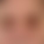 Purpura: Multiple, chronic, bilateral periorbital localized, symmetrical, sharply demarcated, bro...