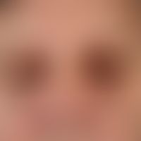 Purpura: Multiple, chronic, bilateral periorbital localized, symmetrical, sharply demarcated, bro...