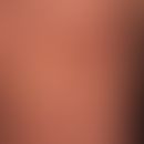 Purpura anularis teleangiectodes: braun-rote anuläre, auch kokardenförmige (Ring-in-Ring-Struktur...