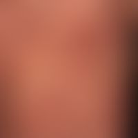Purpura anularis teleangiectodes: brown-red anular, also cocard-like (ring-in-ring structure) by ...
