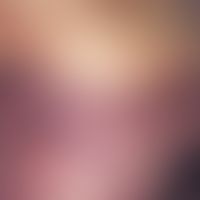 Purpura fulminans: Purpura fulminans beginning in the abdominal region in the context of E. coli ...