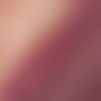 Purpura fulminans - reflected light microscopy (focus in the abdominal area, section): As a resul...