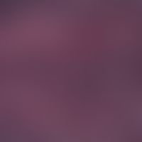 Purpura fulminans - reflected-light microscopy: advanced thrombosis and stagnation hypoxia The en...