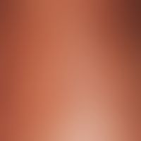 Purpura pigmentosa progressiva. acute episode with dense distribution of punctiform, red, non-pus...