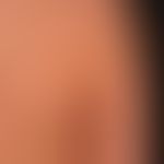 Purpura pigmentosa progressiva. discrete blurred red to red-brown spots. slight itching. occurs a...
