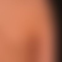 Purpura pigmentosa progressiva. discrete blurred red to red-brown spots. slight itching. occurs a...