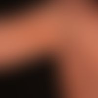 Purpura pigmentosa progressiva. Diskrete unscharf begrenzte rote bis rot-braune Flecken. Leichter...