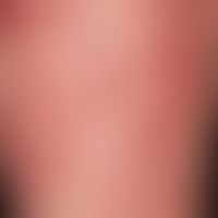 Purpura Schönlein-Henoch:&nbsp;exanthematische Aussaat von punktförmigen Flecken und 0,5-1,0 cm g...