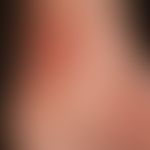 Purpura Schönlein-Henoch:&nbsp;Aussaat kleinster Petechien neben frischen und älteren etwas größe...