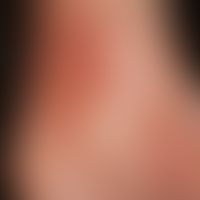 Purpura Schönlein-Henoch:&nbsp;Aussaat kleinster Petechien neben frischen und älteren etwas größe...