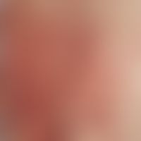 Purpura Schönlein-Henoch. acutely appearing, pinhead to coin-sized spots, papules and plaques, is...