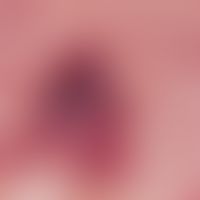 Purpura senilis. Bizarr konfigurierte, frische Einblutung an den Unterarm-Streckseiten bei ältere...
