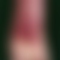Purpura thrombozytopenische: akut aufgetretene, teils großflächige, teils punktförmige, nicht anä...
