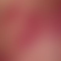 Pustel. Bei einem 62 Jahre alten Patienten mit bekannter CLL (chronischer lymphatischer Leukämie)...